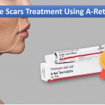 Acne Scars Treatment Using A-Ret Gel