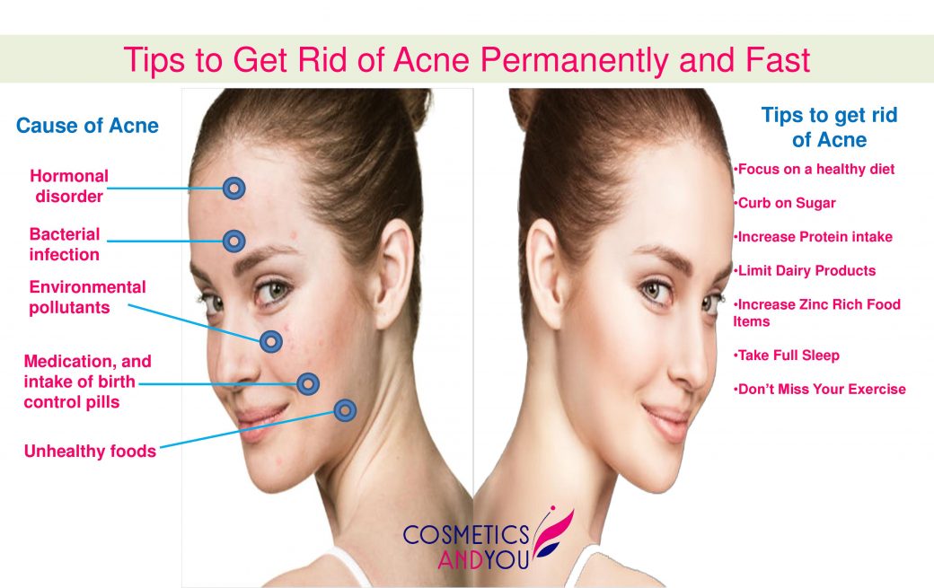 how to get rid of acne fast at home wikihow