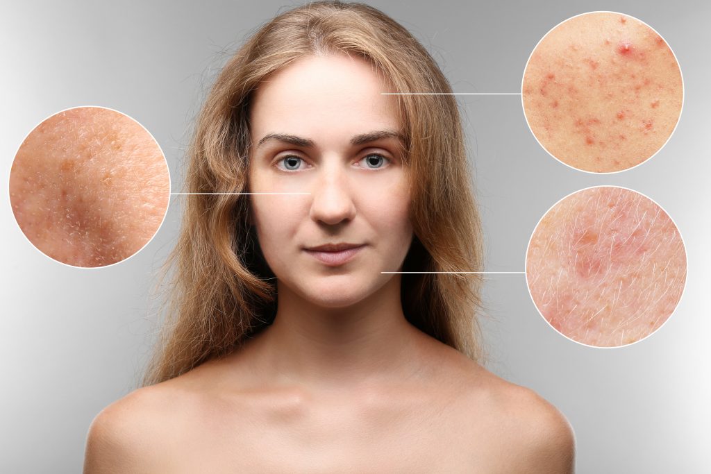 Tretinoin Cream 0.025 Before and After review for Acne