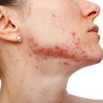 Tri-Luma Cream vs Regular Skin-Lightening Creams: Which One Is Better for Melasma and Dark Spots?