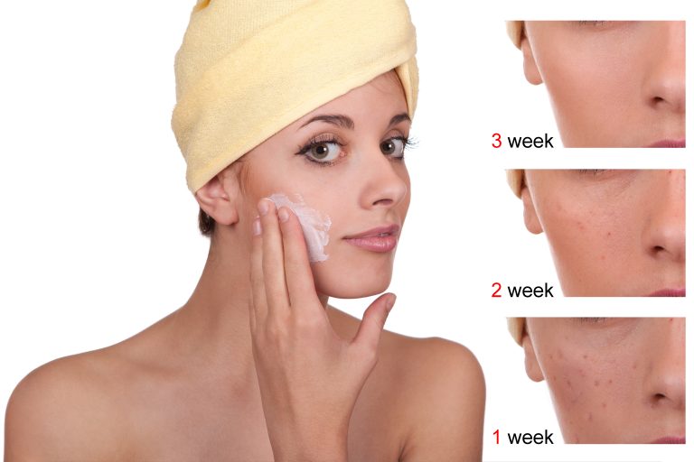 Acne Before and After Using Benzoyl Peroxide Persol Gel Cosmetics and
