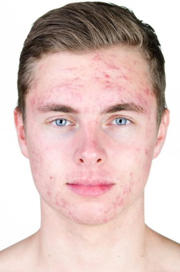 use Benzoyl Peroxide Pimples
