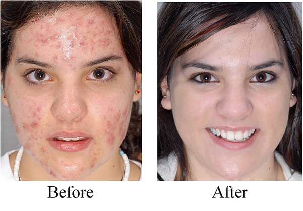 tretinoin-cream-0-025-before-and-after-review-cosmetics-and-you