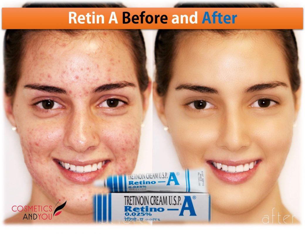 Retin A Before and After