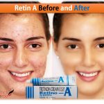Retin A Before and After