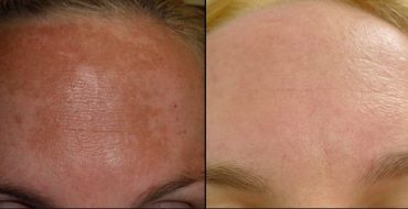 Hydroquinone cream-Best solution to Hyperpigmentation