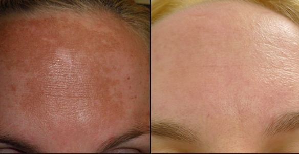 Hydroquinone cream-Best solution to Hyperpigmentation