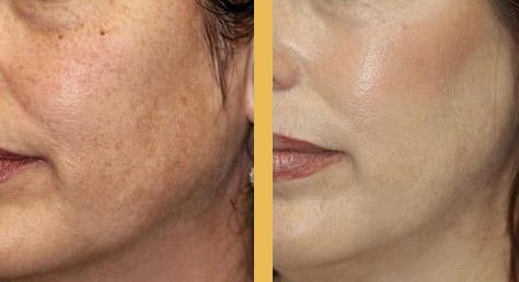 Azelaic Acid Before and After