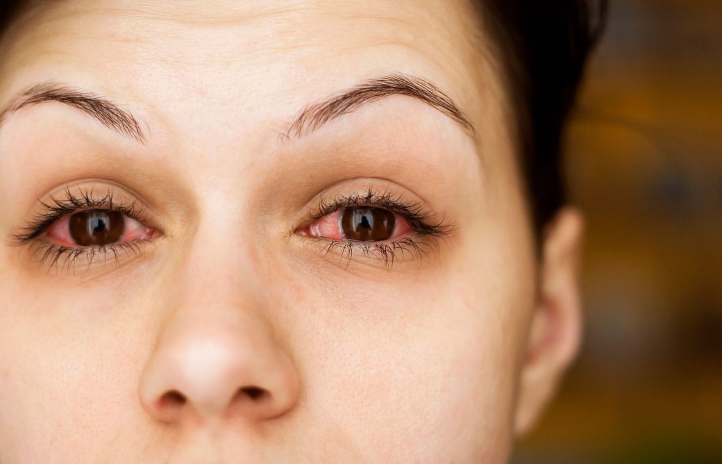 Remedies for Treating Glaucoma Naturally