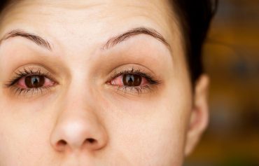 Remedies for Treating Glaucoma Naturally