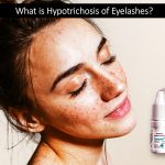 What is hypotrichosis of eyelashes?