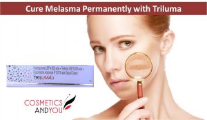 How to Cure Melasma Permanently